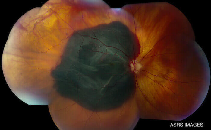 Wet age-related macular degeneration with bleeding