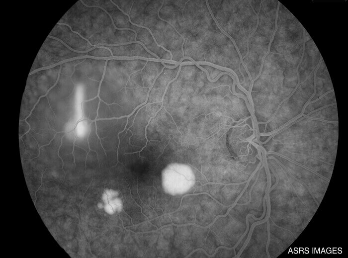 Central serous retinopathy