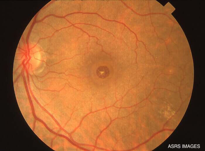 Macular Hole