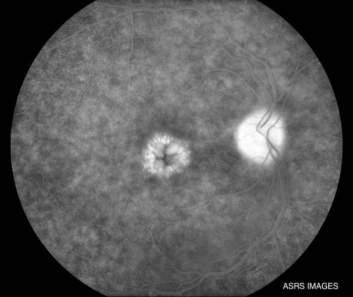 Cystoid Macular edema