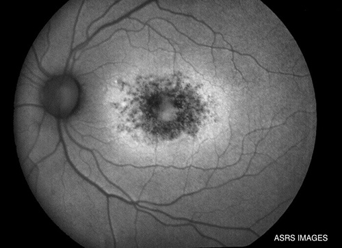 Fundus Autofluorescence