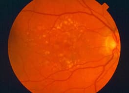 Retinal Photography of Dry macular degeneration