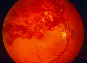 Branch retinal vein occlusion