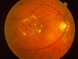 Non-proliferative Diabetic Retinopathy