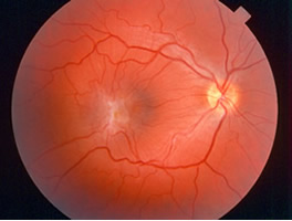 macular pucker with macular dragging