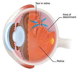 vitreous fluid entering retinal tear, causing retinal detachment