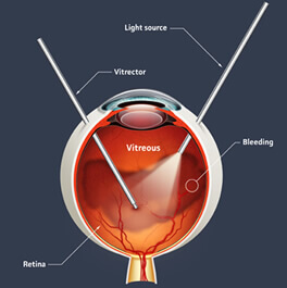 Pars plans vitrectomy for vitreous hemorrhage