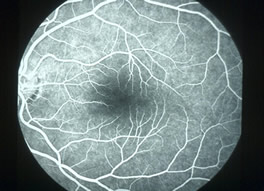 normal flourescein angiogram