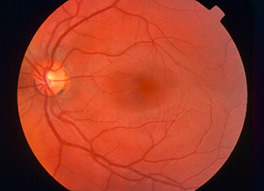 color fundus photograph