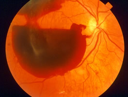 Proliferative Diabetic Retinopathy