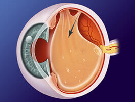 posterior vitreous detachment