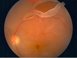 Retinal detachment with retinal tears